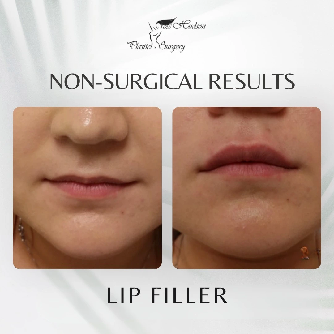 Before and after lip filler results showing fuller lips with enhanced volume and definition
